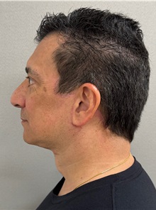 Facelift After Photo by Keshav Magge, MD; ,  - Case 50494