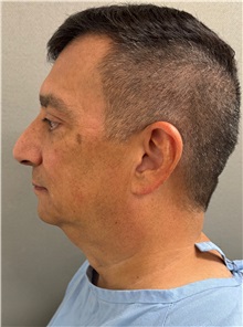 Facelift Before Photo by Keshav Magge, MD; ,  - Case 50494