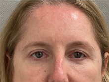 Brow Lift After Photo by Keshav Magge, MD; ,  - Case 50496