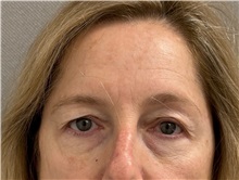 Brow Lift Before Photo by Keshav Magge, MD; ,  - Case 50496
