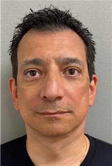 Neck Lift After Photo by Keshav Magge, MD; ,  - Case 50493