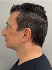 Neck Lift After Photo by Keshav Magge, MD; ,  - Case 50493