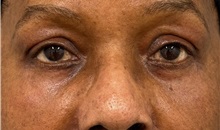 Eyelid Surgery After Photo by Keshav Magge, MD; ,  - Case 50492