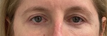 Eyelid Surgery After Photo by Keshav Magge, MD; ,  - Case 50497