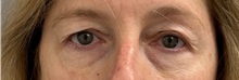 Eyelid Surgery Before Photo by Keshav Magge, MD; ,  - Case 50497