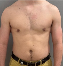 Male Breast Reduction After Photo by Keshav Magge, MD; ,  - Case 50495