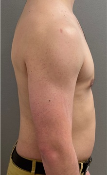 Male Breast Reduction After Photo by Keshav Magge, MD; ,  - Case 50495