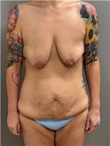 Mommy Makeover Before Photo by Keshav Magge, MD; ,  - Case 50504