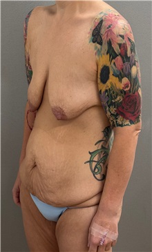 Mommy Makeover Before Photo by Keshav Magge, MD; ,  - Case 50504