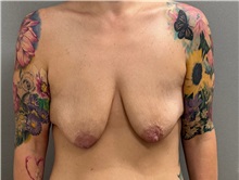 Breast Lift Before Photo by Keshav Magge, MD; ,  - Case 50502