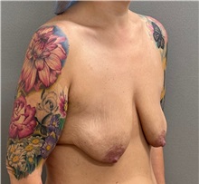 Breast Lift Before Photo by Keshav Magge, MD; ,  - Case 50502