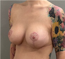 Breast Lift After Photo by Keshav Magge, MD; ,  - Case 50502