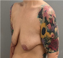 Breast Lift Before Photo by Keshav Magge, MD; ,  - Case 50502