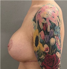 Breast Lift After Photo by Keshav Magge, MD; ,  - Case 50502