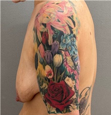 Breast Lift Before Photo by Keshav Magge, MD; ,  - Case 50502