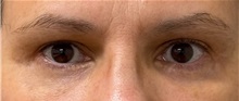 Eyelid Surgery After Photo by Keshav Magge, MD; ,  - Case 50511