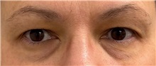 Eyelid Surgery Before Photo by Keshav Magge, MD; ,  - Case 50511
