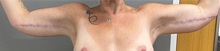 Arm Lift After Photo by Keshav Magge, MD; ,  - Case 50501