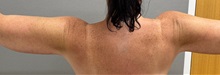 Arm Lift After Photo by Keshav Magge, MD; ,  - Case 50501