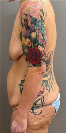 Tummy Tuck Before Photo by Keshav Magge, MD; ,  - Case 50503