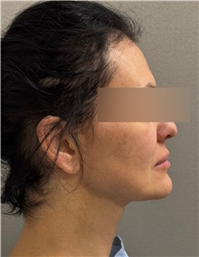 Neck Lift Before Photo by Keshav Magge, MD; ,  - Case 50509