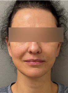 Neck Lift After Photo by Keshav Magge, MD; ,  - Case 50509