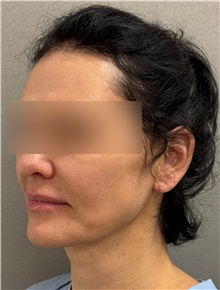 Neck Lift Before Photo by Keshav Magge, MD; ,  - Case 50509