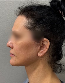 Neck Lift After Photo by Keshav Magge, MD; ,  - Case 50509