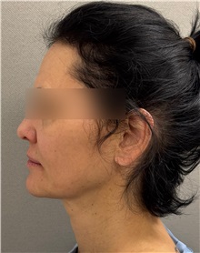 Neck Lift Before Photo by Keshav Magge, MD; ,  - Case 50509