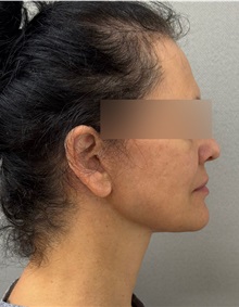 Facelift After Photo by Keshav Magge, MD; ,  - Case 50510