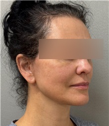 Facelift After Photo by Keshav Magge, MD; ,  - Case 50510
