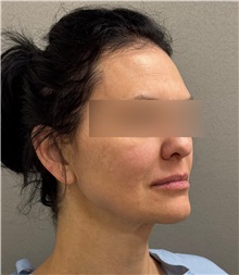 Facelift Before Photo by Keshav Magge, MD; ,  - Case 50510