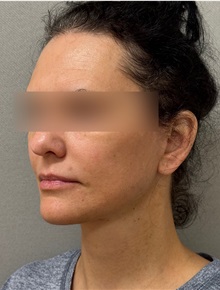 Facelift After Photo by Keshav Magge, MD; ,  - Case 50510