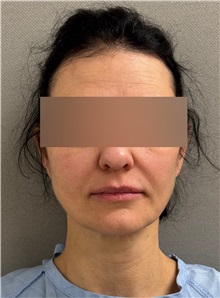 Facelift Before Photo by Keshav Magge, MD; ,  - Case 50510