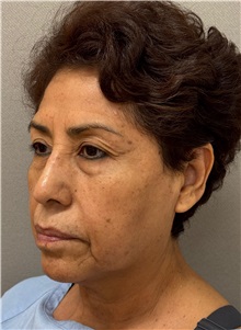 Neck Lift Before Photo by Keshav Magge, MD; ,  - Case 50515