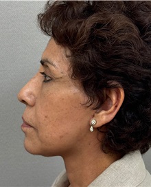 Neck Lift After Photo by Keshav Magge, MD; ,  - Case 50515