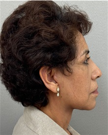 Neck Lift After Photo by Keshav Magge, MD; ,  - Case 50515