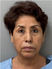 Neck Lift Before Photo by Keshav Magge, MD; ,  - Case 50515