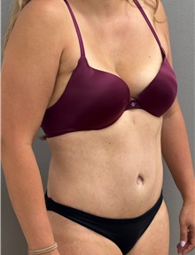 Tummy Tuck After Photo by Keshav Magge, MD; ,  - Case 50518