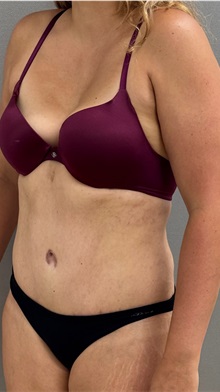 Tummy Tuck After Photo by Keshav Magge, MD; ,  - Case 50518