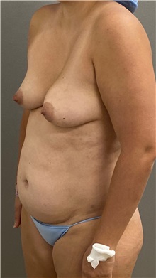 Tummy Tuck Before Photo by Keshav Magge, MD; ,  - Case 50518