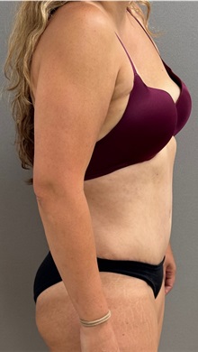 Tummy Tuck After Photo by Keshav Magge, MD; ,  - Case 50518