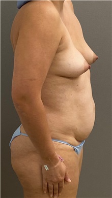 Tummy Tuck Before Photo by Keshav Magge, MD; ,  - Case 50518
