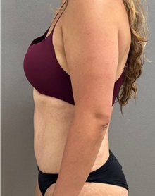 Tummy Tuck After Photo by Keshav Magge, MD; ,  - Case 50518