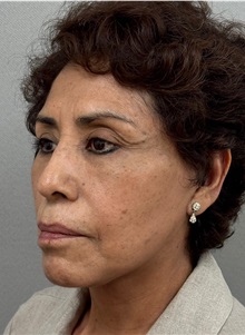 Facelift After Photo by Keshav Magge, MD; ,  - Case 50516