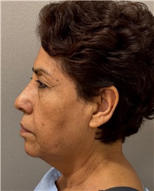 Facelift Before Photo by Keshav Magge, MD; ,  - Case 50516