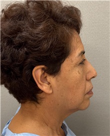 Facelift Before Photo by Keshav Magge, MD; ,  - Case 50516
