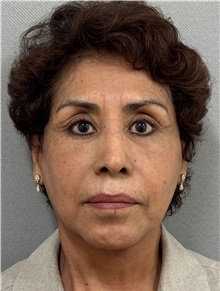 Facelift After Photo by Keshav Magge, MD; ,  - Case 50516