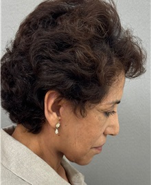Facelift After Photo by Keshav Magge, MD; ,  - Case 50516