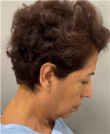 Facelift Before Photo by Keshav Magge, MD; ,  - Case 50516